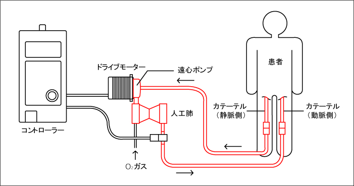 テルモのPCPS/ECMO（VA-ECMO）のしくみ。静脈から脱血して動脈に返血する方法をとっている。遠心ポンプと人工肺で患者の心臓と肺の機能の一部を代行して回復を待つ （画像提供：テルモ株式会社）