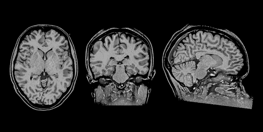 ニューロフィードバック実験中に測定された被験者のMRI画像
